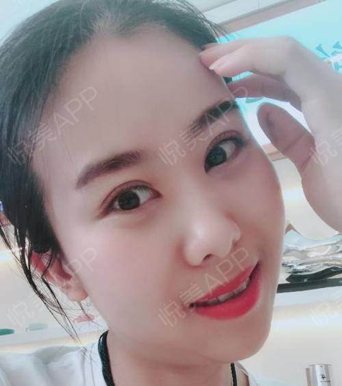 眼睛一點(diǎn)點(diǎn)恢復(fù)，越來越好看 眼部多項(xiàng)手術(shù)的蛻變之旅